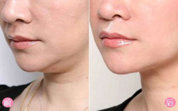 杭州消除額頭紋比較好的整形醫(yī)院排名公布，看看2023年前10位靠譜名單！