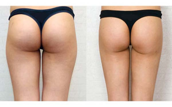 北京治療面部皺紋效果好的自體脂肪注射醫(yī)院哪家靠前？2023年北京自體脂肪注射面部皺紋醫(yī)療醫(yī)院TOP10排名榜