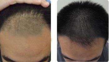 鎮(zhèn)江哪家醫(yī)院效果好？2023年玻尿酸填充額頭美容醫(yī)院排名全新預(yù)測(cè)！