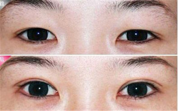 杭州哪家整形醫(yī)院效果好，專業(yè)解決祛痘坑痘印問題，2023很受歡迎的前十家！