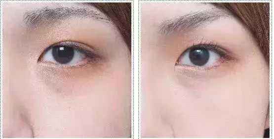 2023德州眼底紋玻尿酸注射整形美院排行榜，你知道嗎？