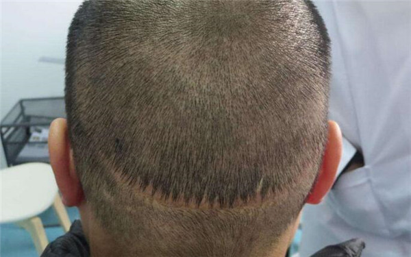 重慶十家熱門醫(yī)院推薦！2023重慶超聲去除黑眼圈美容醫(yī)院精選十強(qiáng)深度評(píng)判！