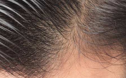 2023年牡丹江比較推崇的玻尿酸填充隆胸?？漆t(yī)院排行榜來(lái)啦！