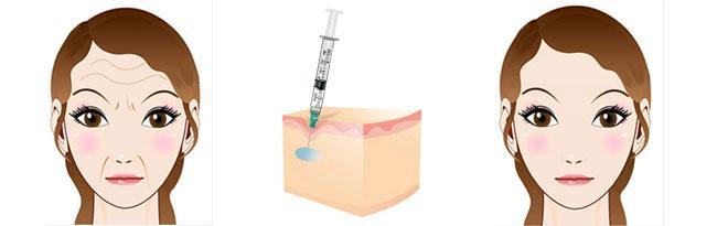 2023年溫州哪家整形醫(yī)院效果比較好？去生長紋，熱拉提推薦！