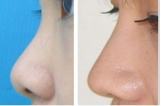 2023年海南哪家整形醫(yī)院口碑好？填充淚溝效果受網(wǎng)友推薦的醫(yī)院有哪些？