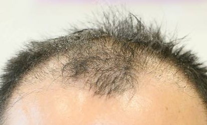 南寧有哪些給人注射木偶紋的醫(yī)療美容醫(yī)院效果好？2023年南寧木偶紋注射整形醫(yī)院排行榜前10強評選揭曉！