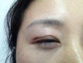 北京眼部熊貓針注射熱門醫(yī)院排名榜單揭秘，術(shù)前必看指南！