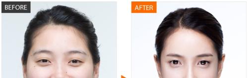 上海顴弓降低醫(yī)院口碑排行榜及醫(yī)生分享！最新權(quán)威榜單解讀