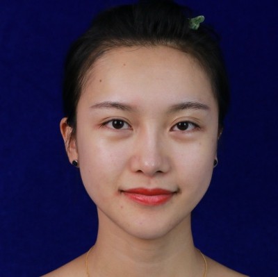 眼綜合術(shù)前VS術(shù)后，自然大眼睛值得稱贊！