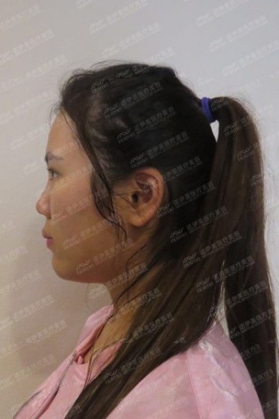 呼和浩特諾伊美劉星赫醫(yī)師鼻部多項(xiàng)手術(shù)案例反饋