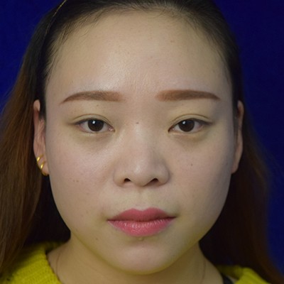 術(shù)前矮低平，術(shù)后高挺翹~肋軟骨隆鼻效果好的不得了！