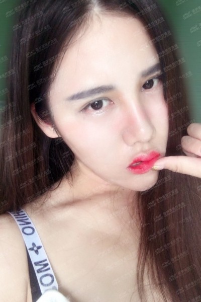 呼和浩特諾伊美劉星赫醫(yī)師鼻部多項(xiàng)手術(shù)案例反饋