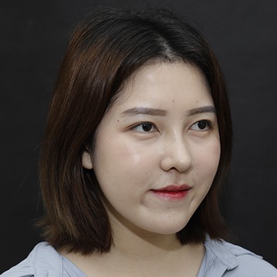 廣州美恩半肋鼻手術(shù)恢復(fù)效果反饋，主任親自操刀的效果就是贊！