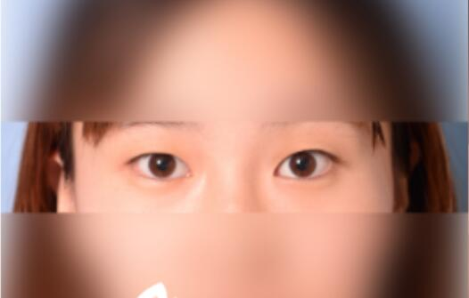 延吉金光善整形雙眼皮一個月效果分享，有對比圖