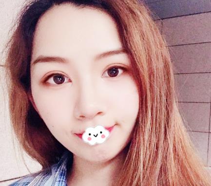 武漢伊萊美割雙眼皮案例分享術后一個月效果