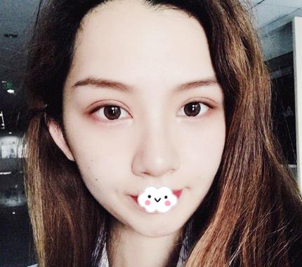 武漢伊萊美割雙眼皮案例分享術后半個月效果