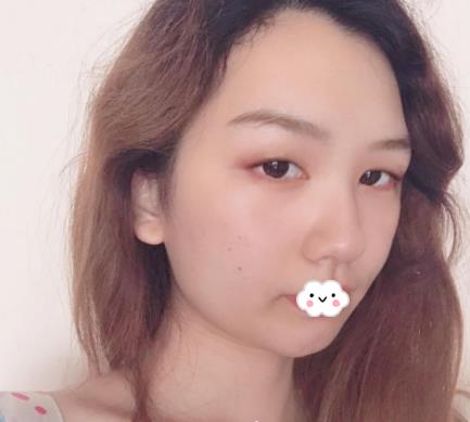 武漢伊萊美割雙眼皮案例分享術前效果