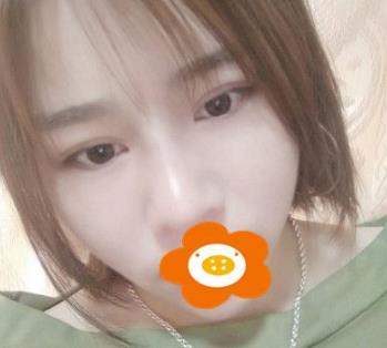 杭州薇琳隆鼻術(shù)后三個(gè)月效果