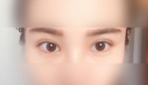 延吉金光善整形雙眼皮一個月效果 延吉金光善整形雙眼皮一個月效果