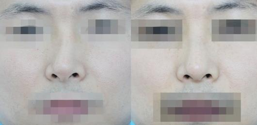 不要被營銷號帶偏了，鼻骨矯正其實很簡單