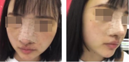 哈爾濱成美整形周小生鼻綜合案例術(shù)后兩天