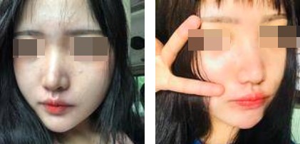 哈爾濱成美整形周小生鼻綜合案例前后對比圖