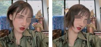 哈爾濱成美整形周小生鼻綜合案例術(shù)后兩個月