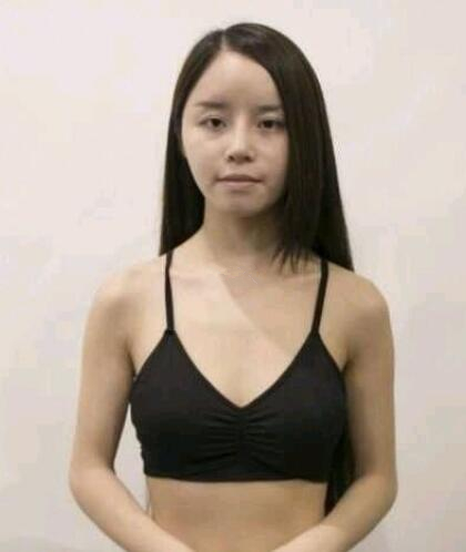 福州海峽假體隆胸案例術前