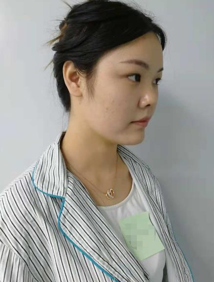 長沙雅美眼鼻整形案例分享，術后這滿滿的混血感是腫么回事