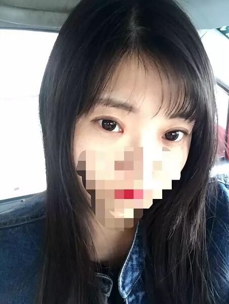 北京京民雙眼皮修復(fù)案例術(shù)后兩個月