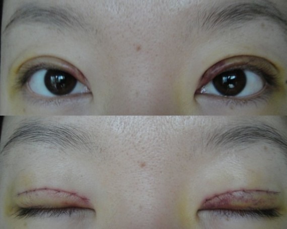 鄭州望京做全切雙眼皮+開外眼角術后一周 鄭州望京做全切雙眼皮+開外眼角術后一周