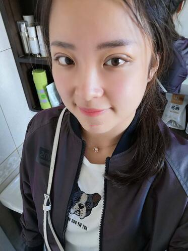 濟(jì)南韓式整形雙眼皮術(shù)后二十天