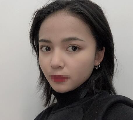 長(zhǎng)沙愛思特整形定點(diǎn)雙眼皮案例分享，蘿莉到御姐的轉(zhuǎn)變