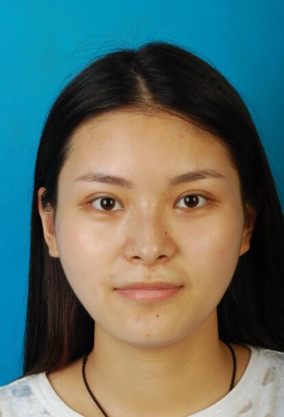 西安國際下頜角整形案例分享，怪不得都說整形要先輪廓后五官