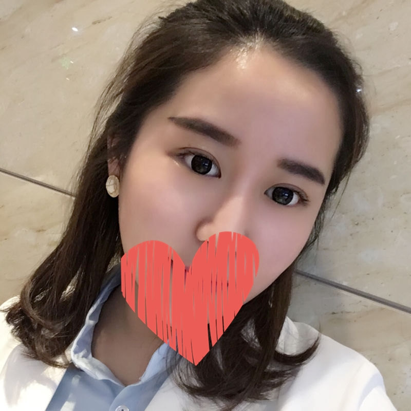 滄州中妤整形張明切開雙眼皮案例分享