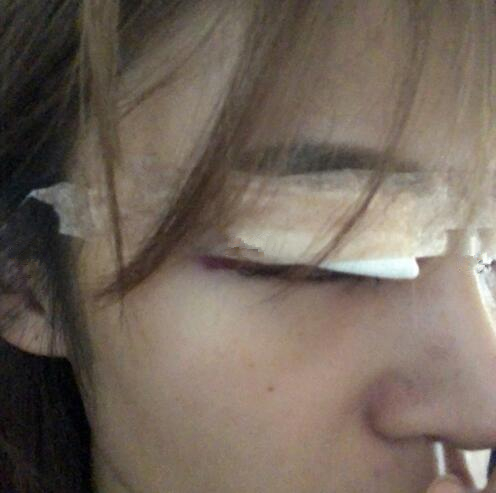 北京崔相平整形雙眼皮修復案例分享