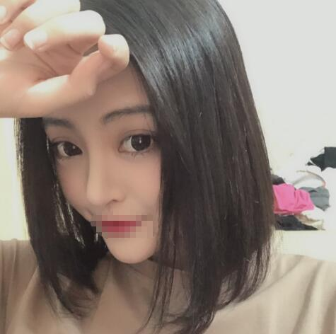 上海賽美瑞整形張化舉鼻綜合術(shù)后兩個月效果分享