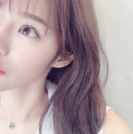 北京崔相平整形雙眼皮修復(fù)一個(gè)月效果