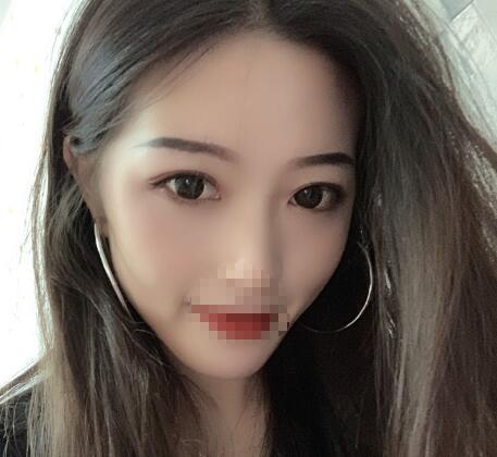 北京美萊整形杜園園雙眼皮三個月效果