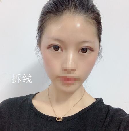 北京美萊整形杜園園雙眼皮拆線后效果