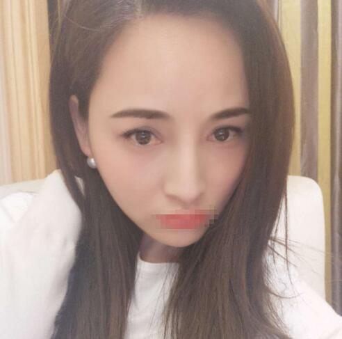 赤峰現(xiàn)代婦產醫(yī)院醫(yī)療美容科袁俊龍雙眼皮修復案例分享