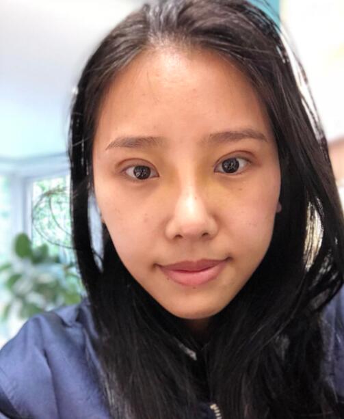 煙臺(tái)華怡整形張上海切開雙眼皮拆線后