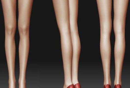 佛山市第一人民醫(yī)院整形美容小腿吸脂術(shù)后效果