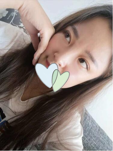 青島伊美爾劉長發(fā)做雙眼皮怎么樣？