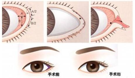 哈爾濱禾力康醫(yī)療開外眼角術(shù)后效果
