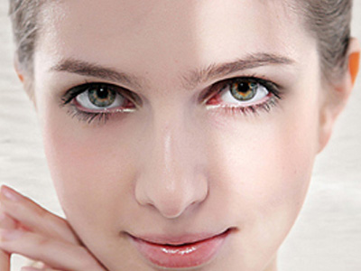 哈爾濱索菲整形美容開(kāi)眼角術(shù)后效果