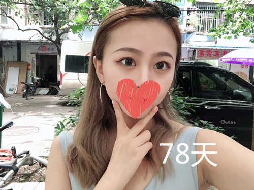 杭州靜港林忠泵埋線雙眼皮案例1-7天效果圖分享，讓你的眼睛魅力四射