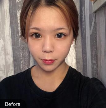 做自體脂肪填充手術(shù)前 做自體脂肪填充手術(shù)前