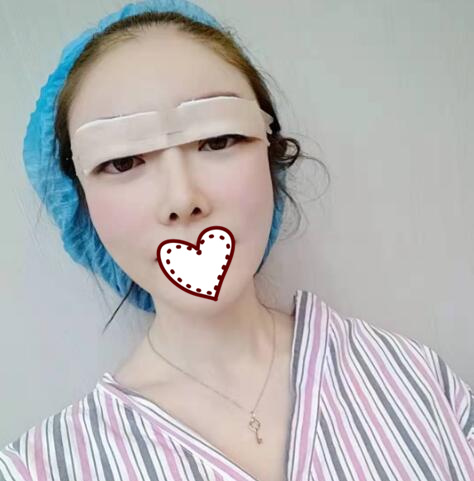 剛做完雙眼皮手術(shù)，還在恢復(fù)過程中