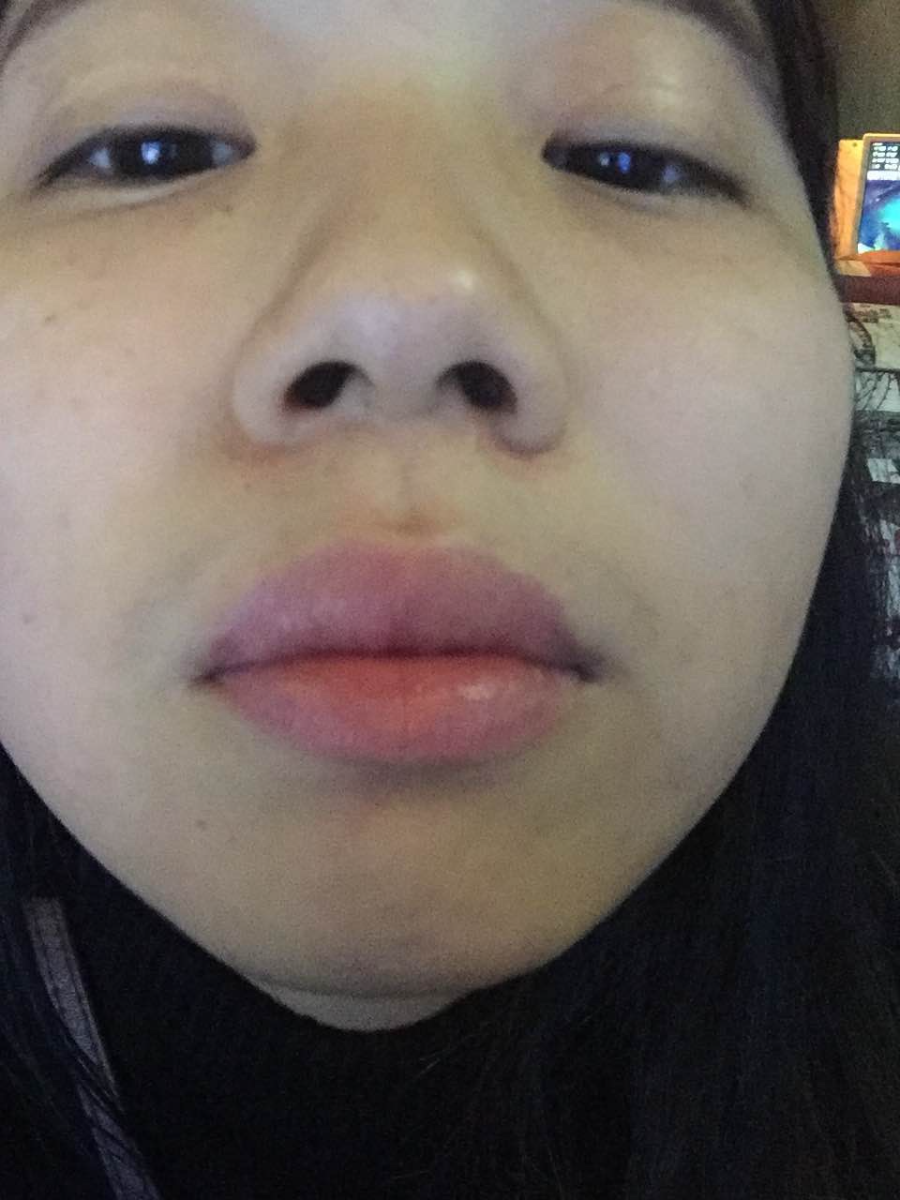 滄州瑞美醫(yī)療美容門診部王波醫(yī)生鼻骨縮窄案例，拯救了我的丑鼻子